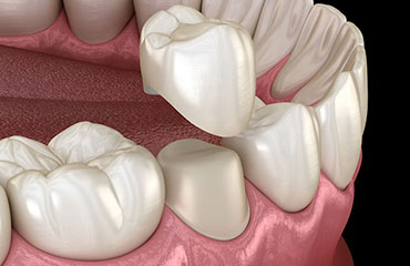 A dental crown being inserted over the top of an existing tooth.