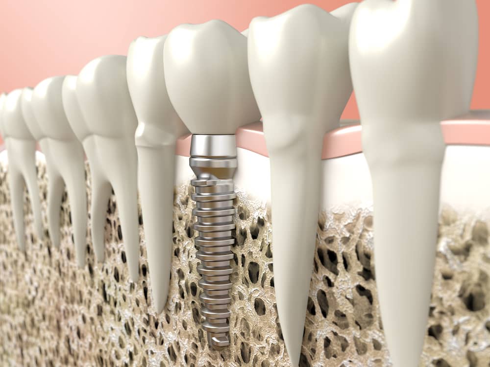 Dental implants shown digitally how they are screwed in.