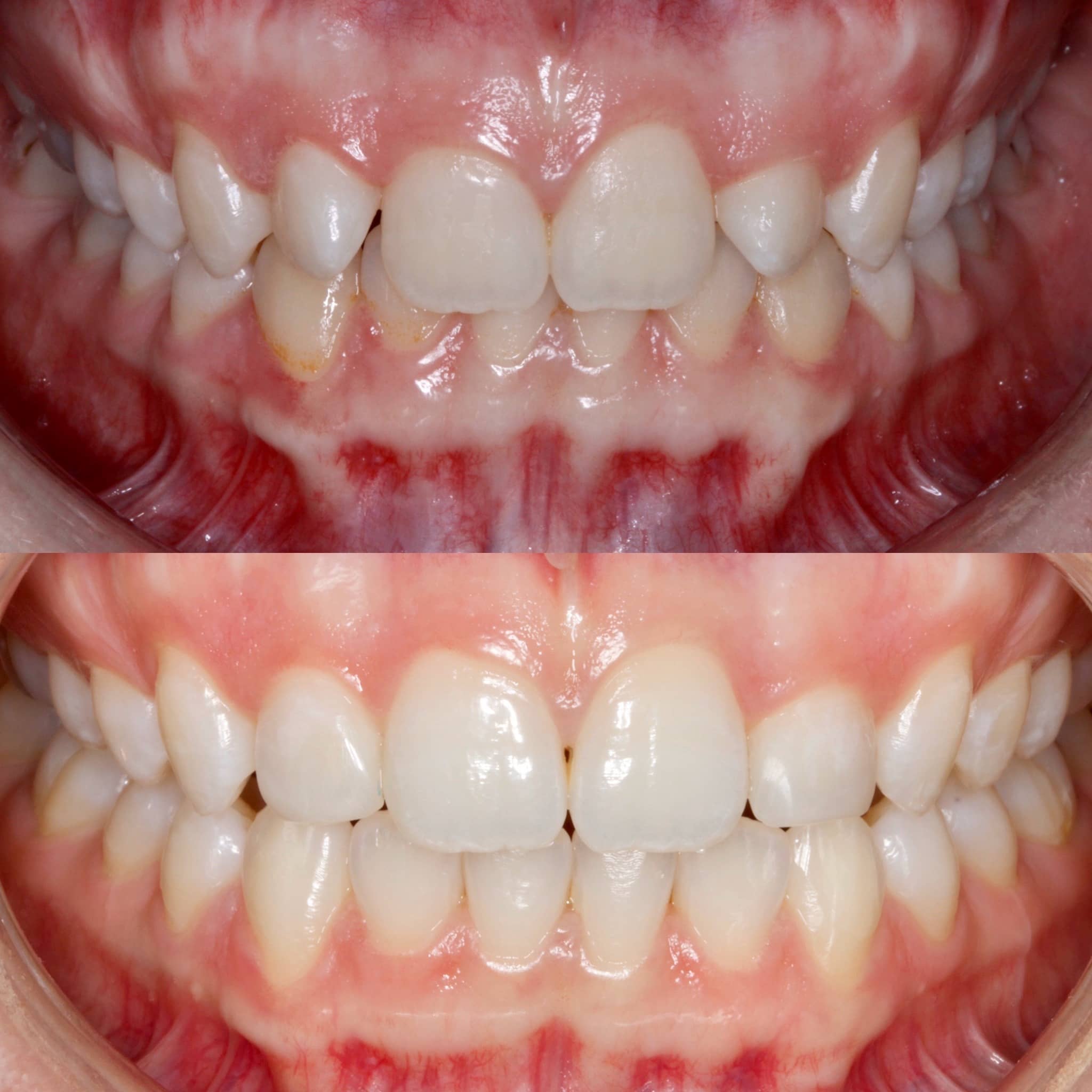 Teeth up close showing what before and after teeth bonding looks like.