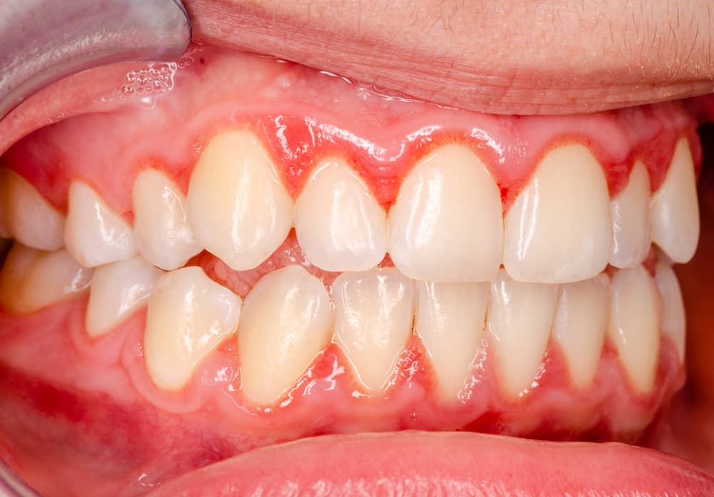 A mouth showing first stage gingivitis around the gums.
