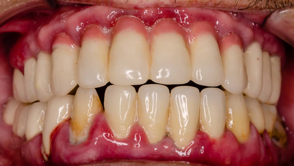 Second stage periodontis showing sore and unhealthy looking gums.