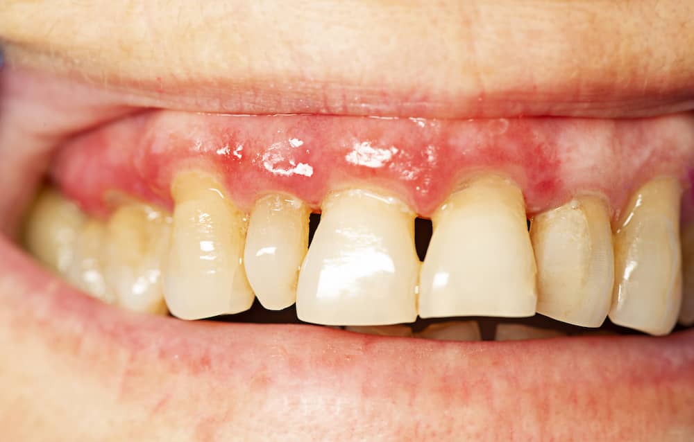 Third stage periodontis showing bad tooth erosion.