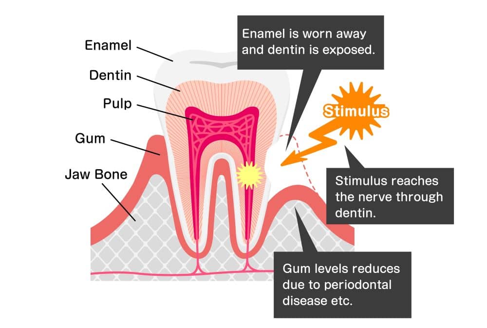 Cause of teeth sensitivity illustration..