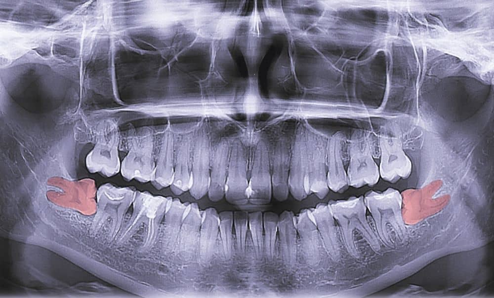 Dental x-ray that show wisdom teeth.