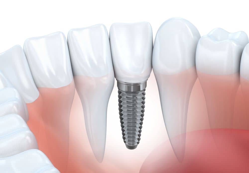 Dental implant illustration.