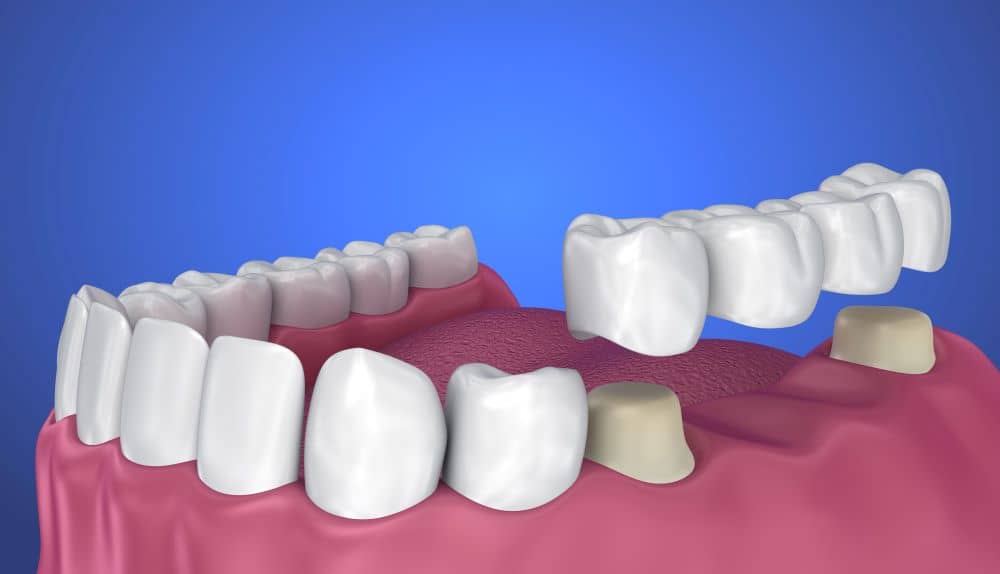 Tooth-supported fixed bridge.