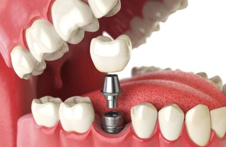 Tooth implant.