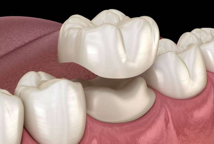 Dental crown replacement illustration