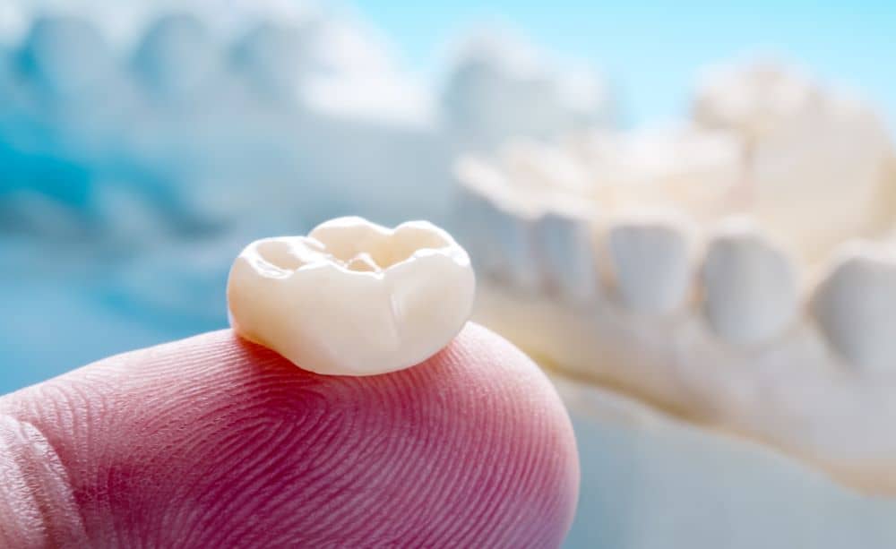 Can You Whiten Dental Crowns? Dental Clinic