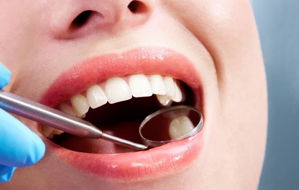 Cavity-Free for Life: The Benefits of Dental Fillings