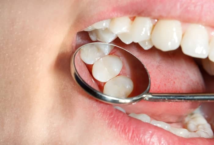 Composites are the better options for those who want more realistic-looking fillings.