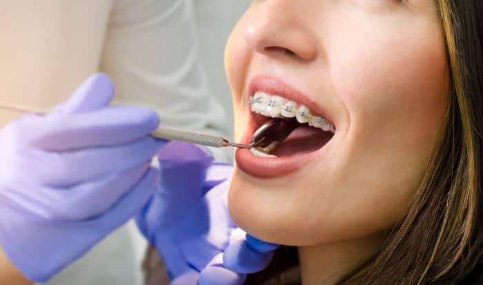 Once you get your braces on, cleaning your teeth thoroughly is crucial.