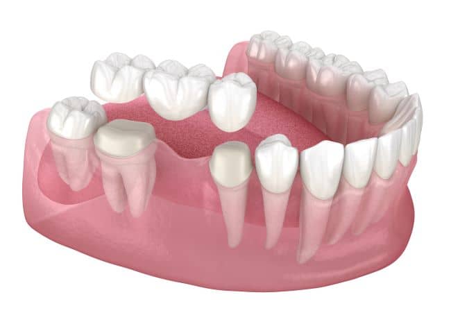A tooth-supported bridge provides the same realistic look and feel of that of a dental implant