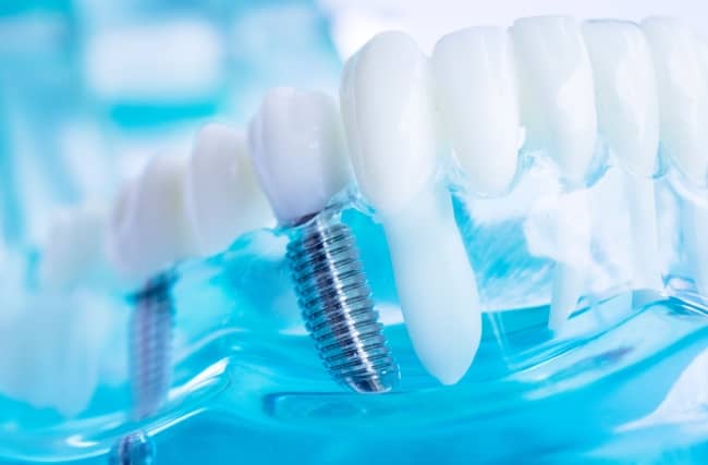 Dental implants are becoming increasingly popular due to their appearance and durability.