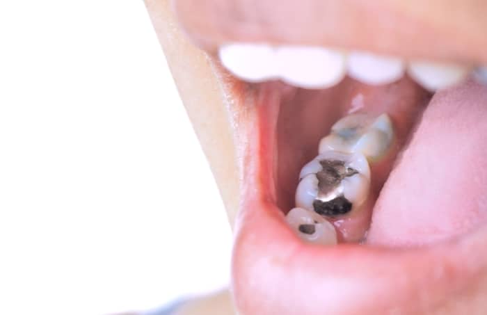 Dental fillings that are made of silver amalgam have been around the longest.