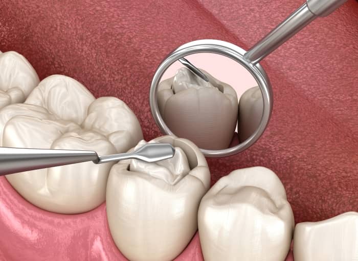 As long as your cavity hasn’t yet affected the pulp of your tooth, you will be recommended a tooth filling.