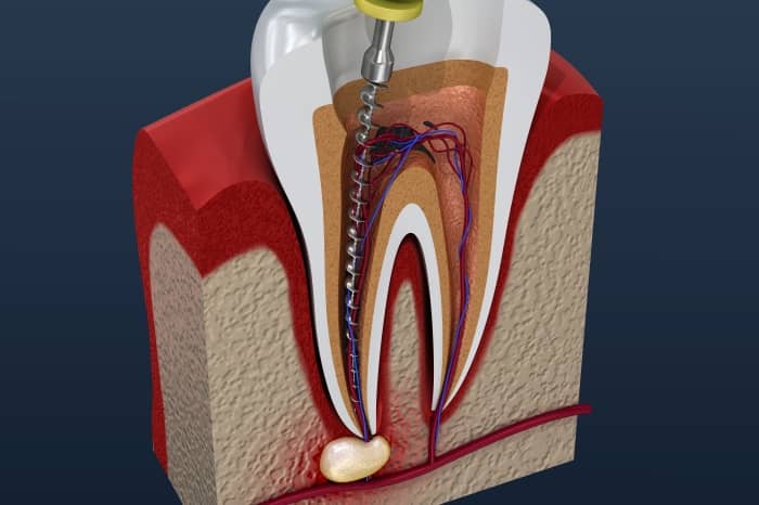 Root canals are the next step after fillings as they fix what fillings cannot so you do not have to lose your tooth or teeth.