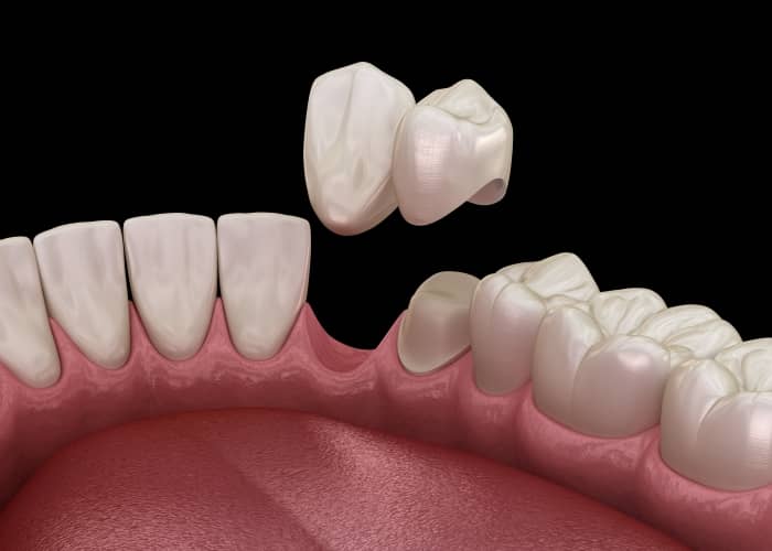 Cantilever bridges are similar to a traditional dental bridge, but only use one natural tooth to help secure the replacement tooth.