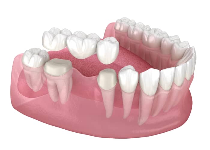 A dental bridge can replace a tooth or several teeth.
