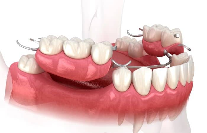 Removable dental bridges — also known as partial dentures — feature a plastic, gum-coloured base that gets secured to surrounding teeth with metal clasps.