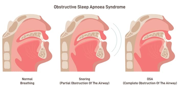 Obstructive Sleep Apnoea (OSA) is more than snoring; it occurs when an airway is fully or partially blocked during sleep.