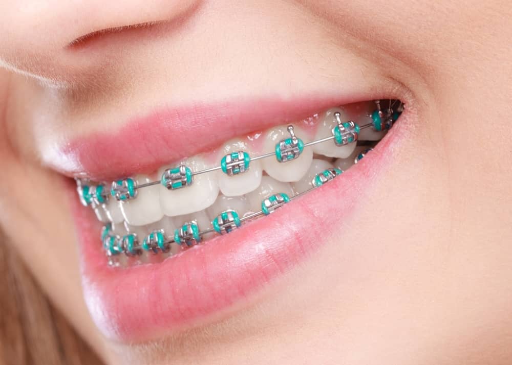 Metal braces or traditional braces are also a type of dental treatment that straighten teeth but do so using metal brackets and wiring.