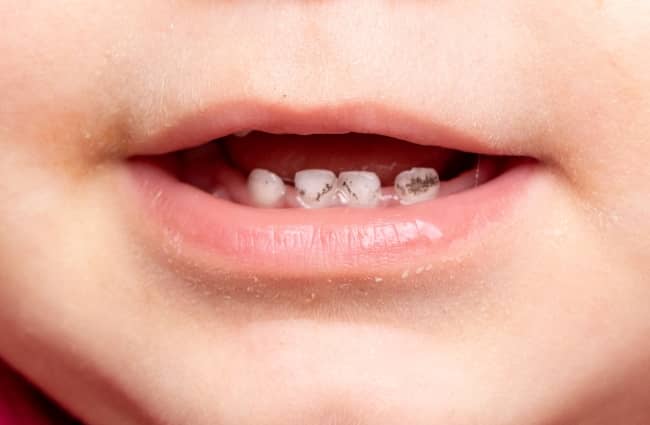 Discoloration and minor pitting are the two prominent signs of cavities in baby’s teeth.