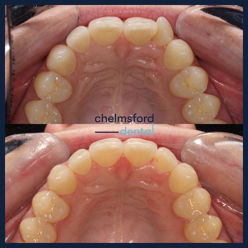 before and after shot of teeth after dental clean