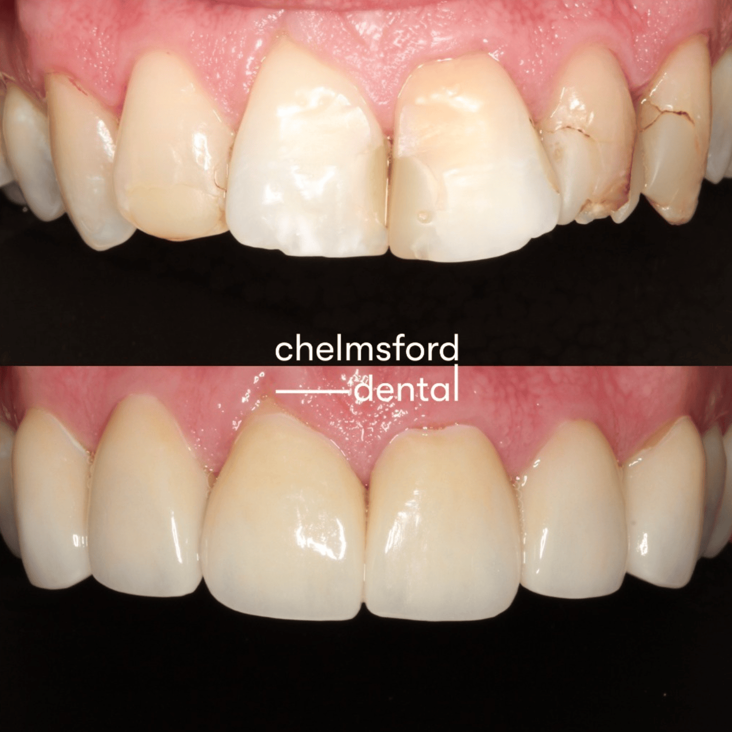 comparison photo before and after dental veneers