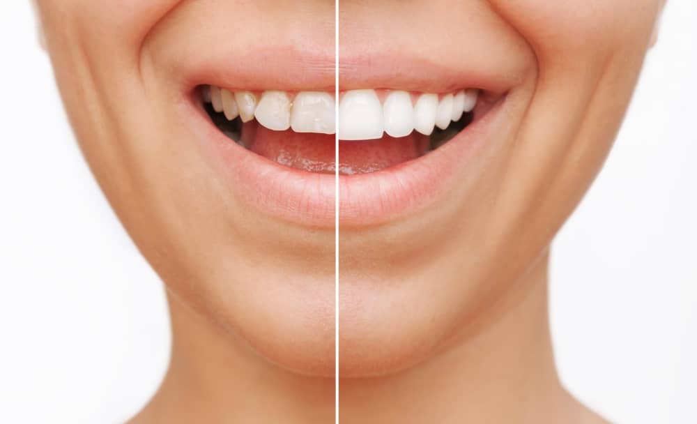 Porcelain veneers and composite veneers are both popular options for enhancing the appearance of teeth.