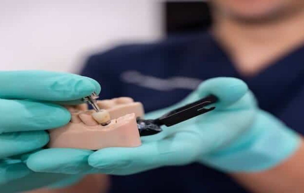 Dental Implants in Perth Process, Recovery and What to Expect