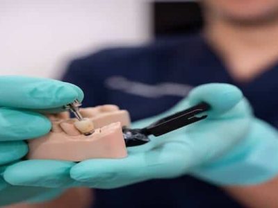 Dental Implants in Perth Process, Recovery and What to Expect