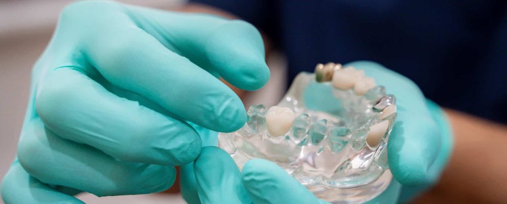 Dental crown restoration at Chelmsford Dental Mount Lawley
