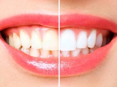Before and after teeth whitening.