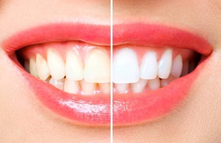 Before and after teeth whitening.