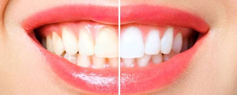 Before and after teeth whitening.