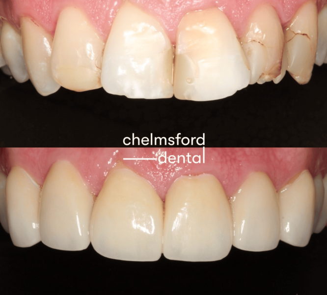 comparison photo before and after dental veneers
