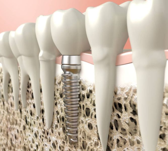 Dental implants shown digitally how they are screwed in.