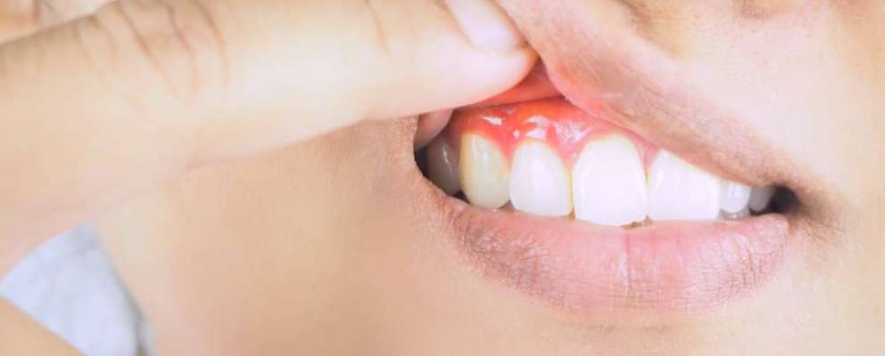 Gum disease that could develop into gingivitis.