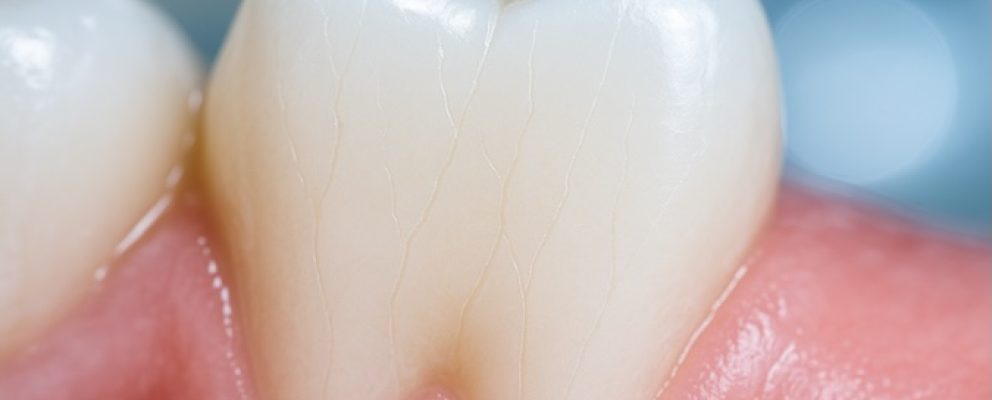 a tooth with hairline crack