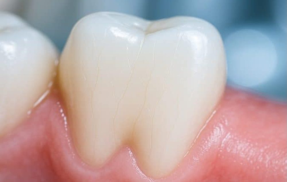 a tooth with hairline crack