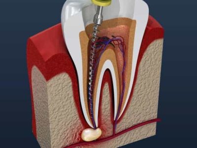 Root canals are the next step after fillings as they fix what fillings cannot so you do not have to lose your tooth or teeth.