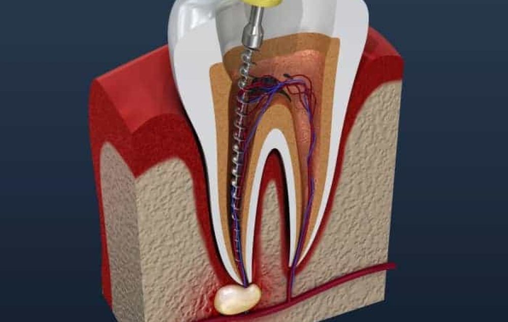 Root canals are the next step after fillings as they fix what fillings cannot so you do not have to lose your tooth or teeth.
