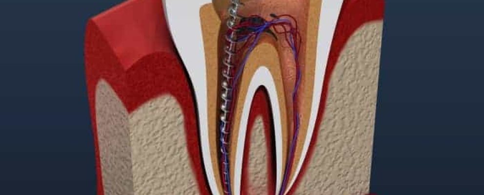 Root canals are the next step after fillings as they fix what fillings cannot so you do not have to lose your tooth or teeth.