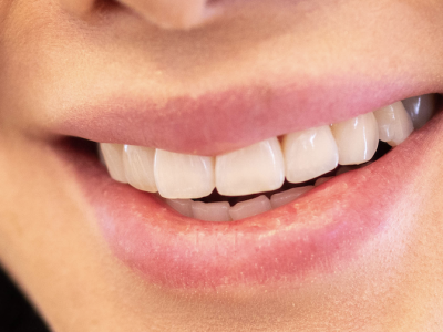 White and straight teeth from a Chelmsford Dental patient.