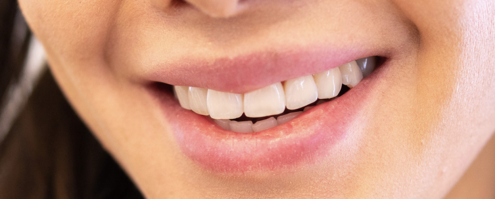 White and straight teeth from a Chelmsford Dental patient.