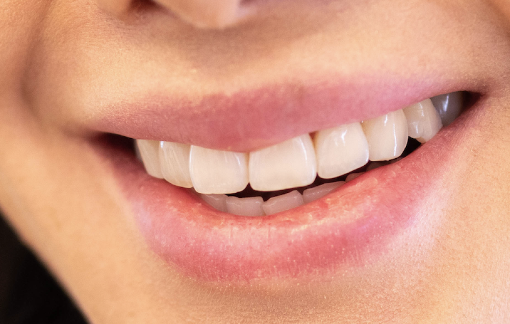 White and straight teeth from a Chelmsford Dental patient.