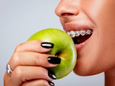 Your orthodontist will instruct you to be precautious with your eating habits when you get braces, and for good reason.