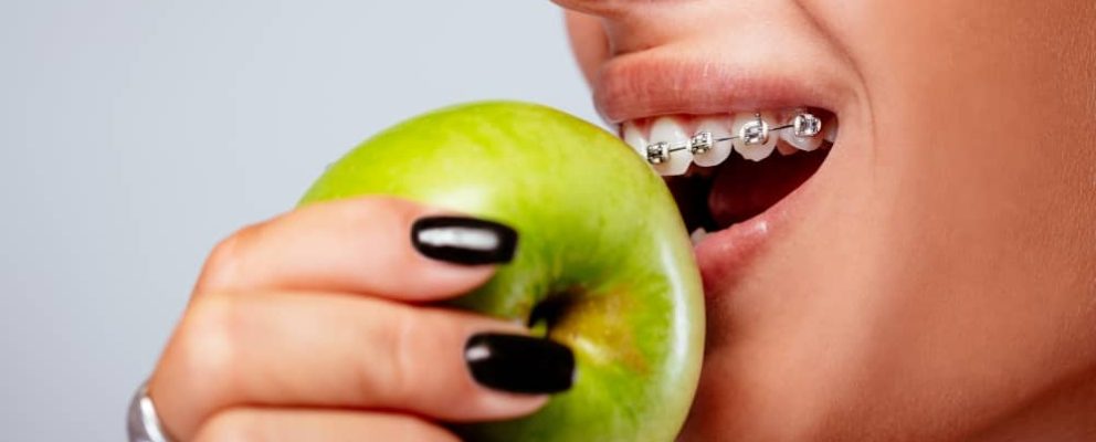 Your orthodontist will instruct you to be precautious with your eating habits when you get braces, and for good reason.