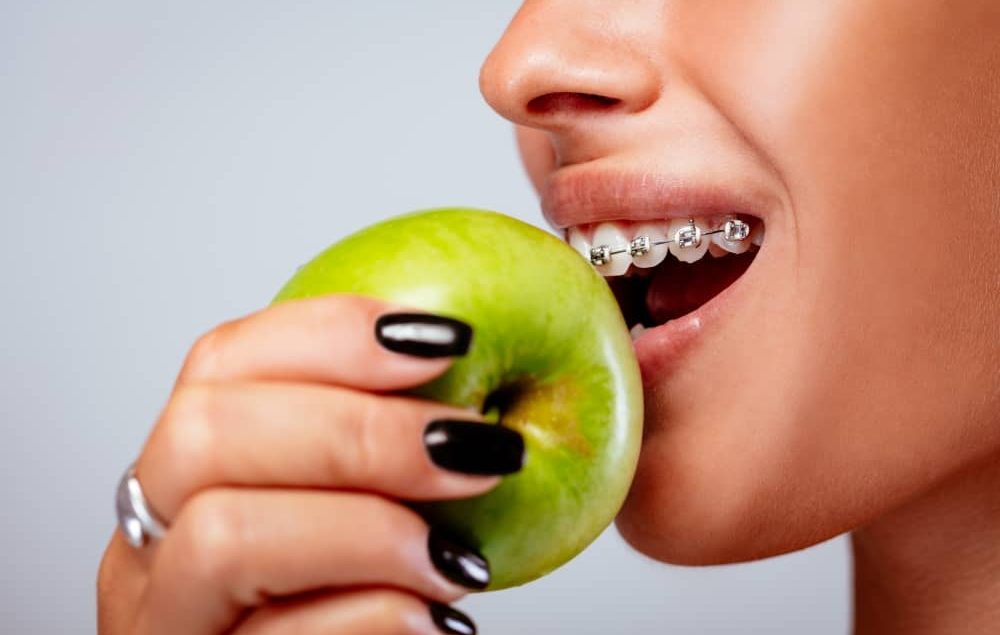 Your orthodontist will instruct you to be precautious with your eating habits when you get braces, and for good reason.